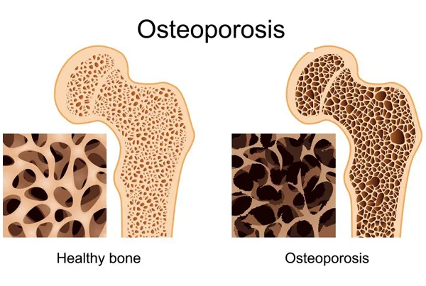 Osteoporosis Complete Panel