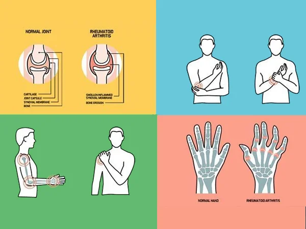 Rheumatoid