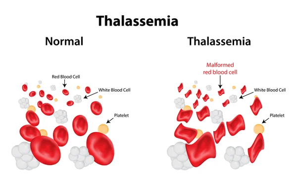 Thalaseemia Comprehensive